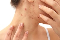 Women with adult pimples