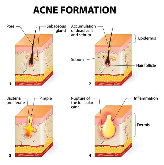 testochecker adult acne formation