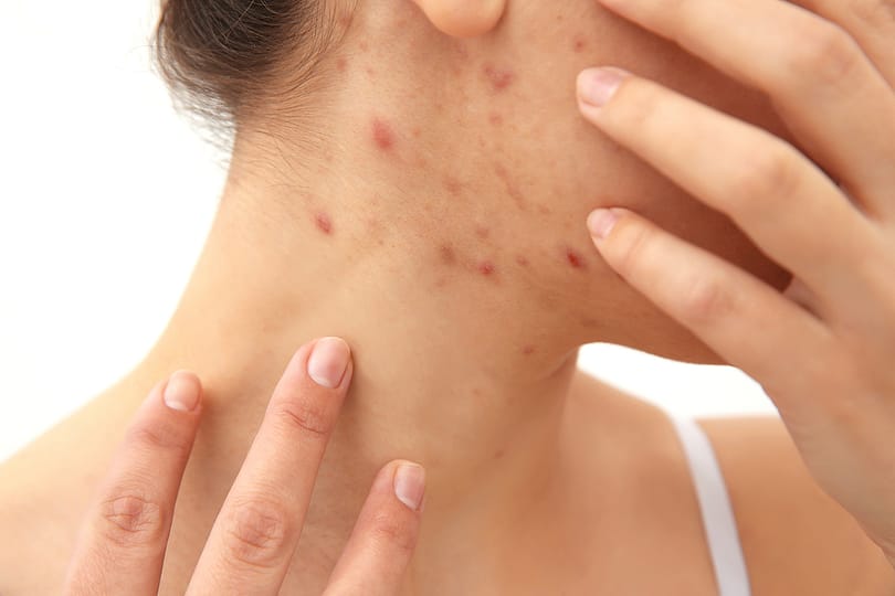 Women with adult pimples