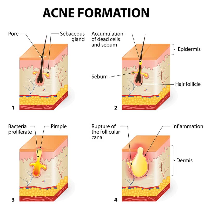 testochecker adult acne formation